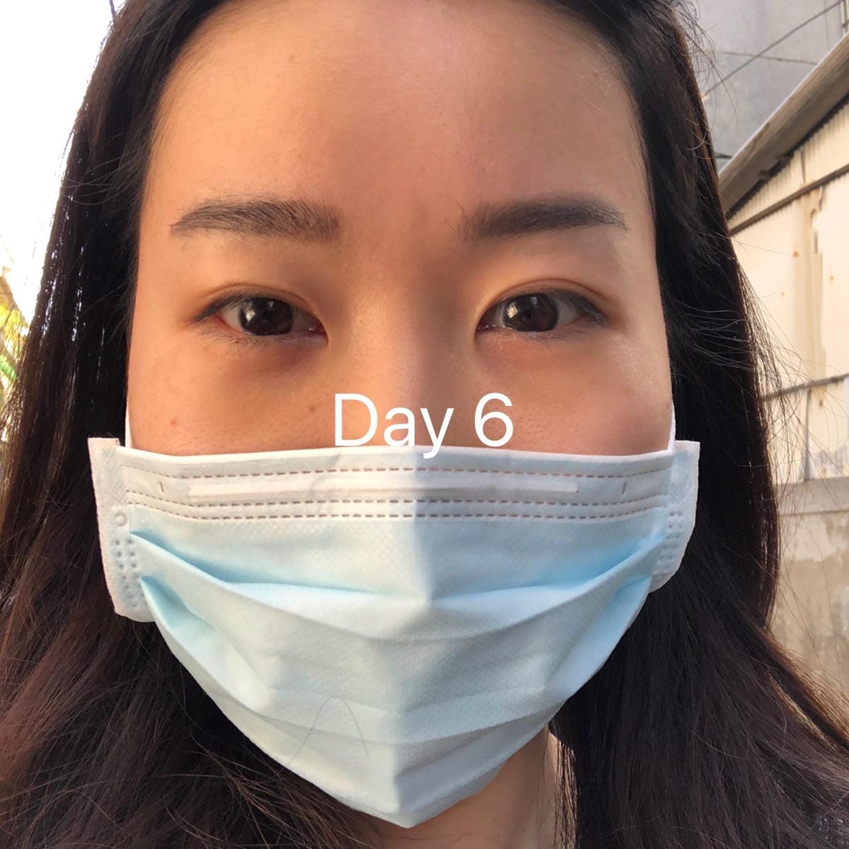 眼袋手術(內開) saybyebye復原紀錄 | 佳思優整形