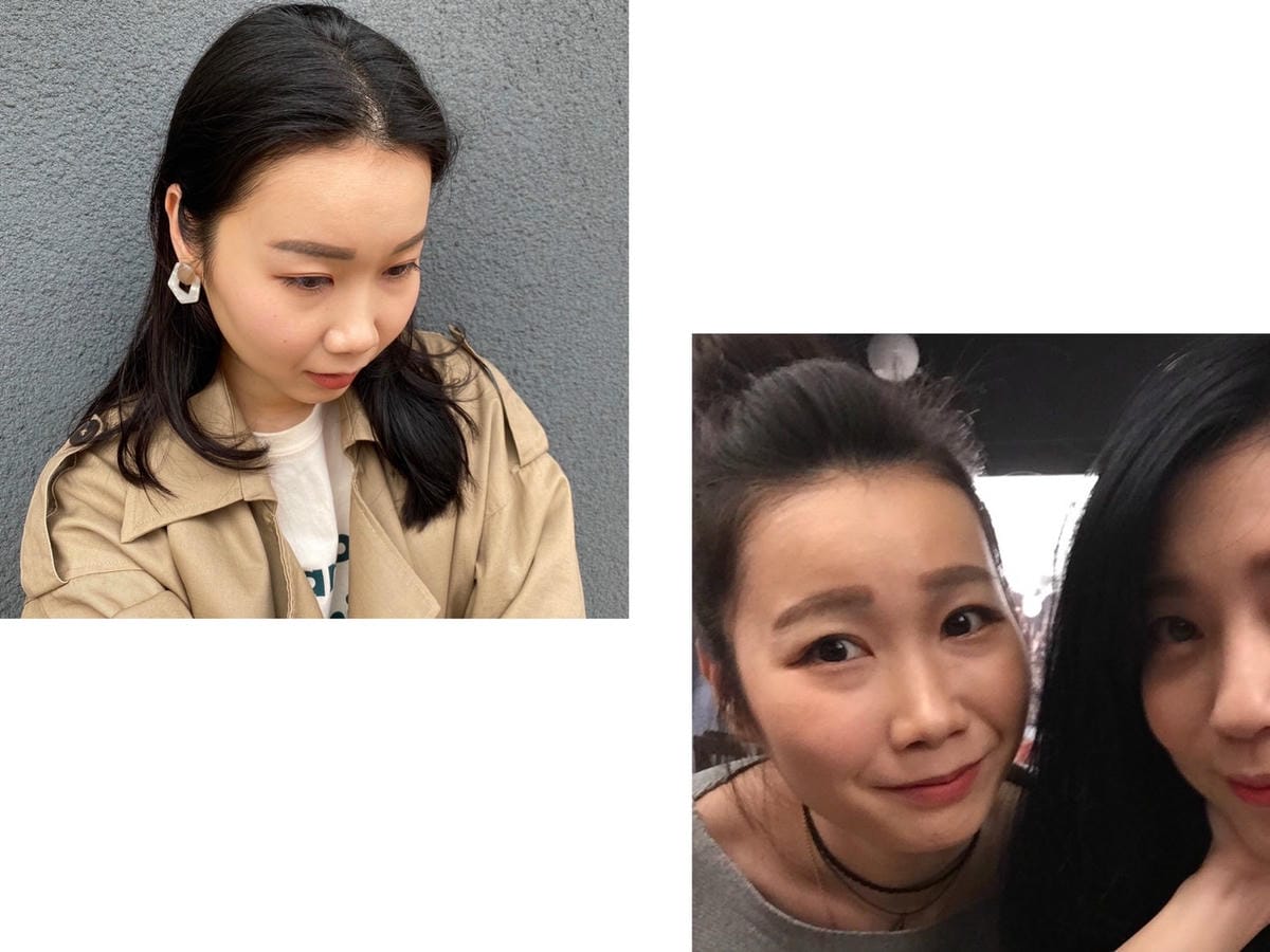 眼袋手術(內開) saybyebye復原紀錄 | 佳思優整形