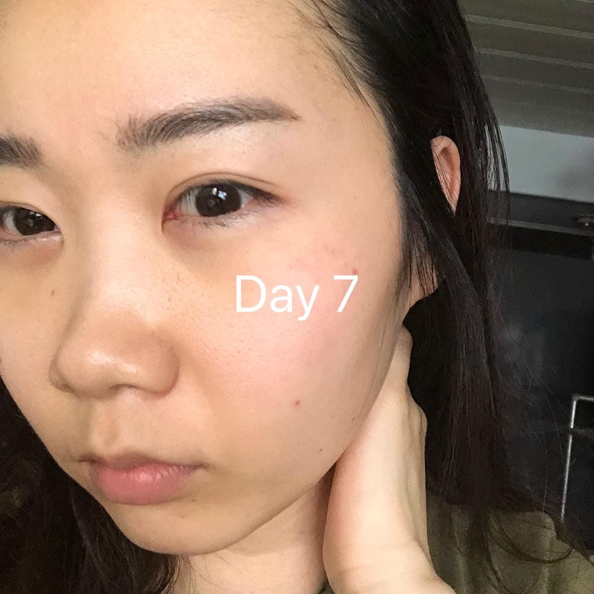 眼袋手術(內開) saybyebye復原紀錄 | 佳思優整形