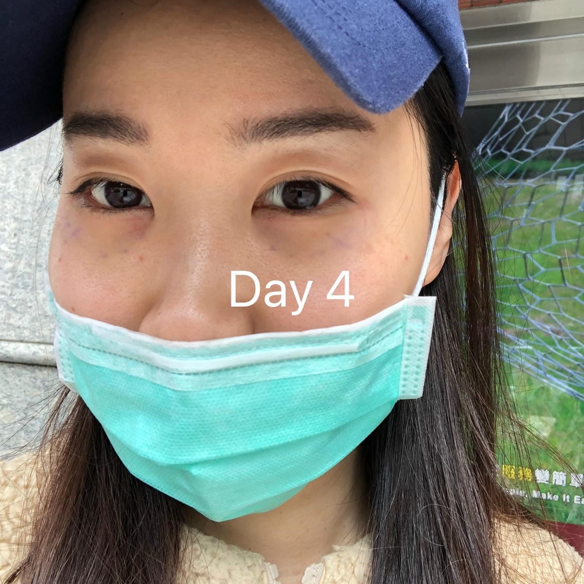 眼袋手術(內開) saybyebye復原紀錄 | 佳思優整形