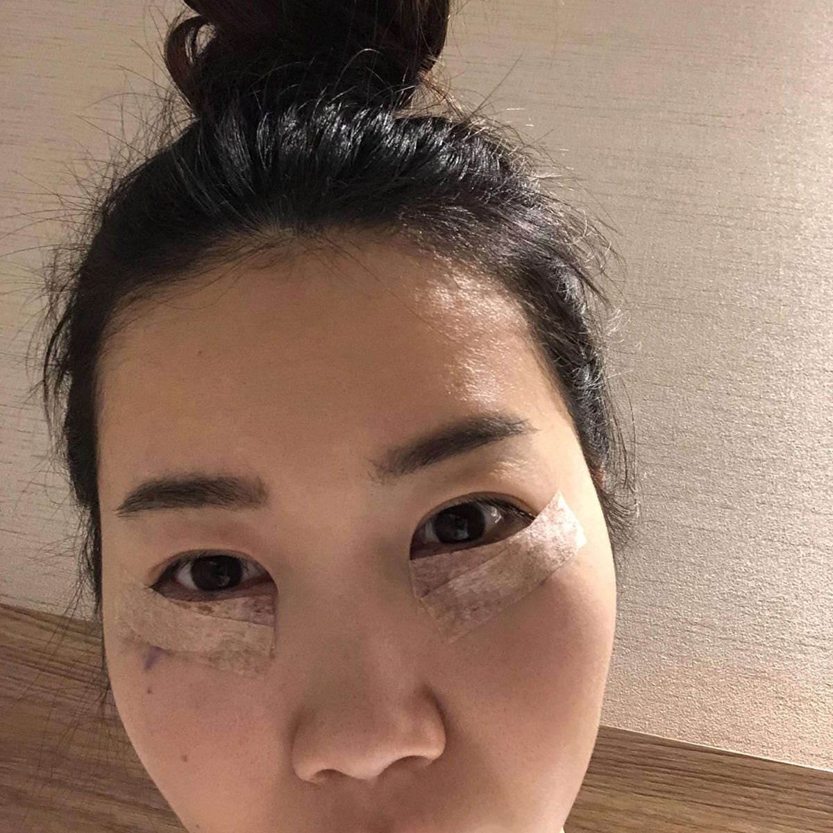 眼袋手術(內開) saybyebye復原紀錄 | 佳思優整形