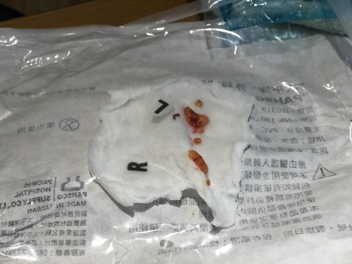 眼袋手術(內開) saybyebye復原紀錄 | 佳思優整形