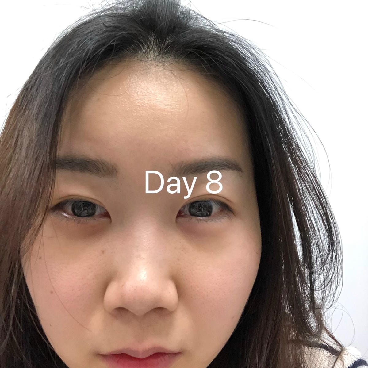 眼袋手術(內開) saybyebye復原紀錄 | 佳思優整形