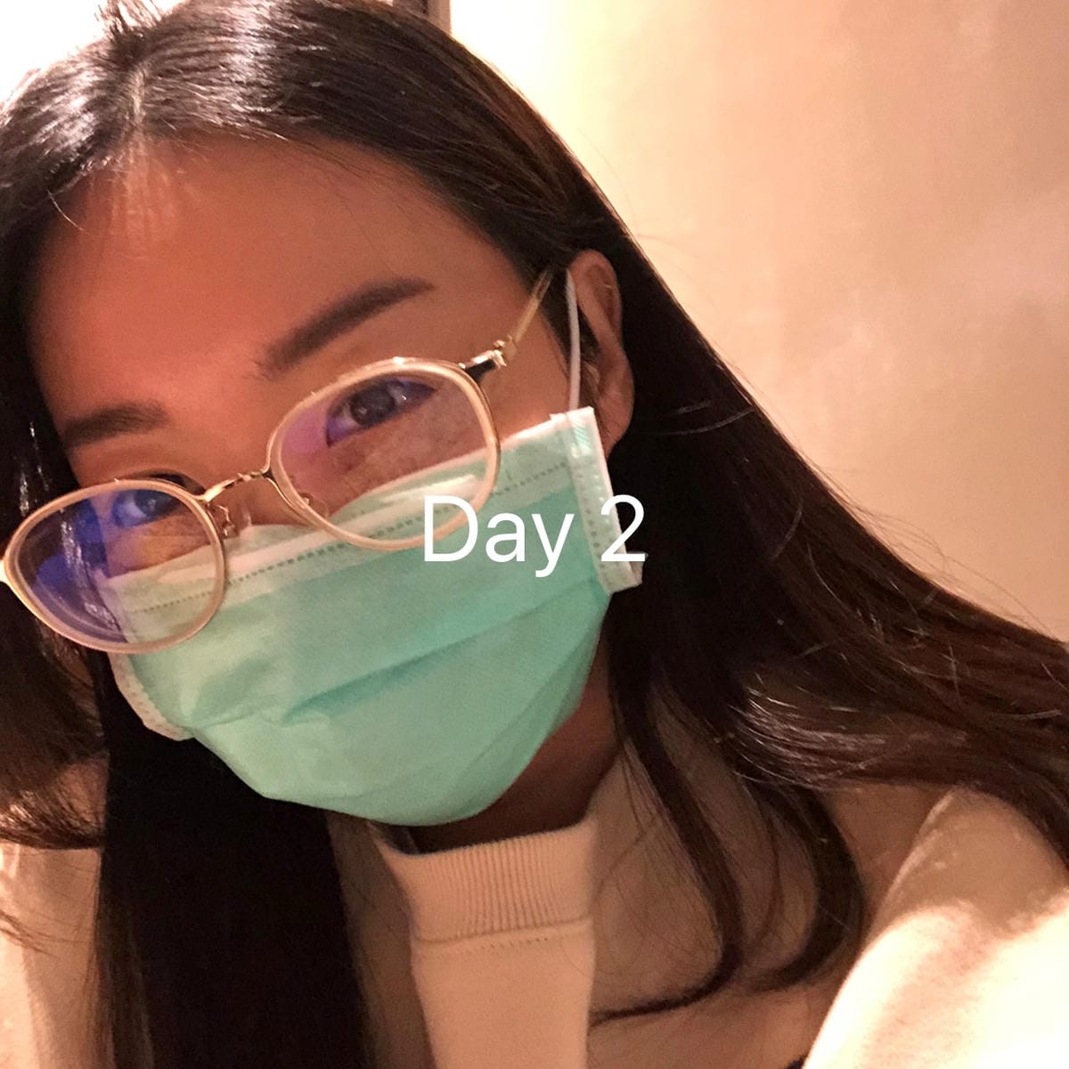 眼袋手術(內開) saybyebye復原紀錄 | 佳思優整形