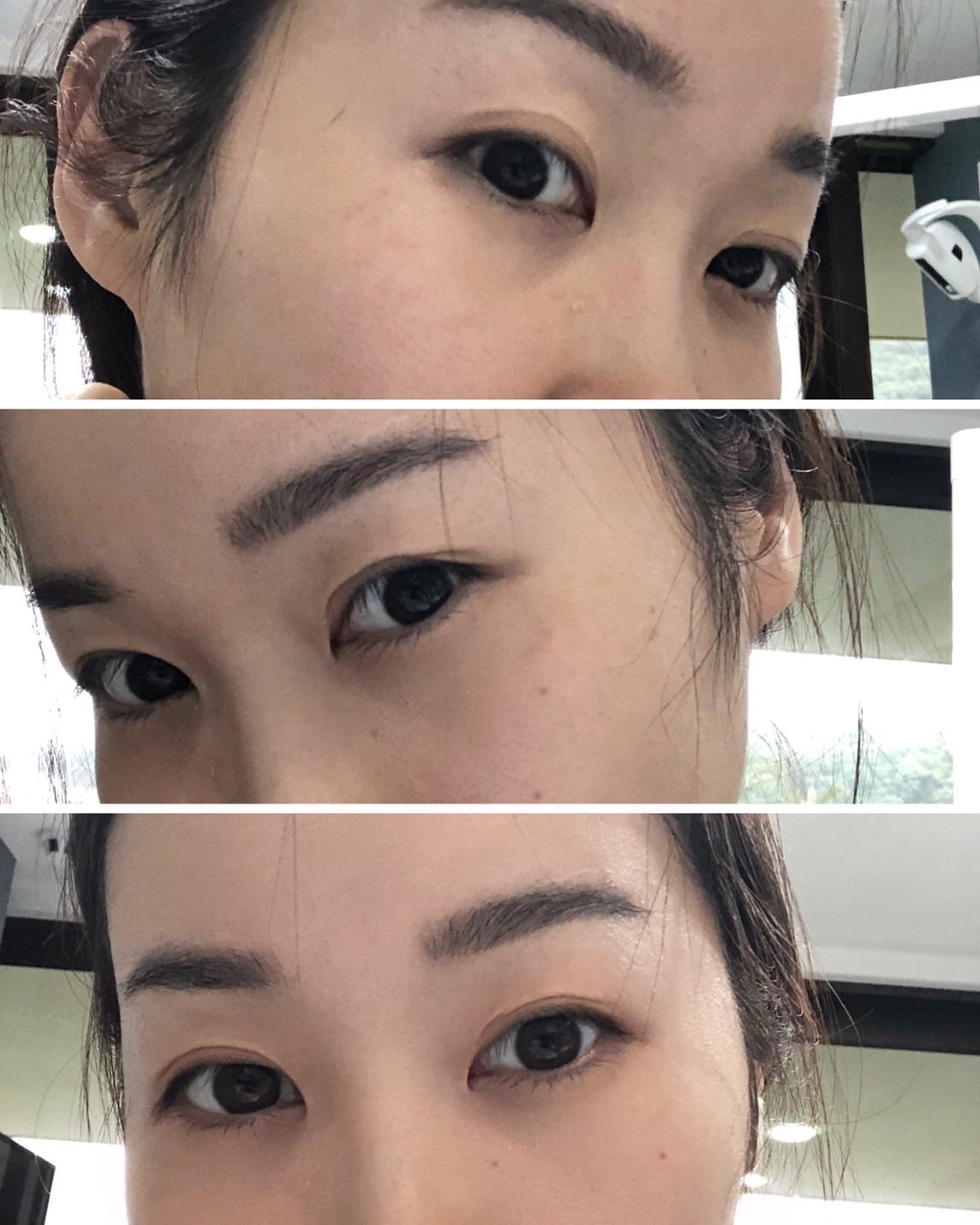 眼袋手術(內開) saybyebye復原紀錄 | 佳思優整形