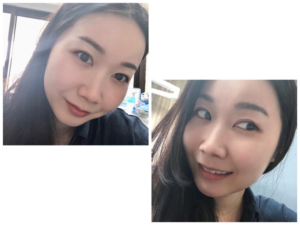 眼袋手術(內開) saybyebye復原紀錄 | 佳思優整形