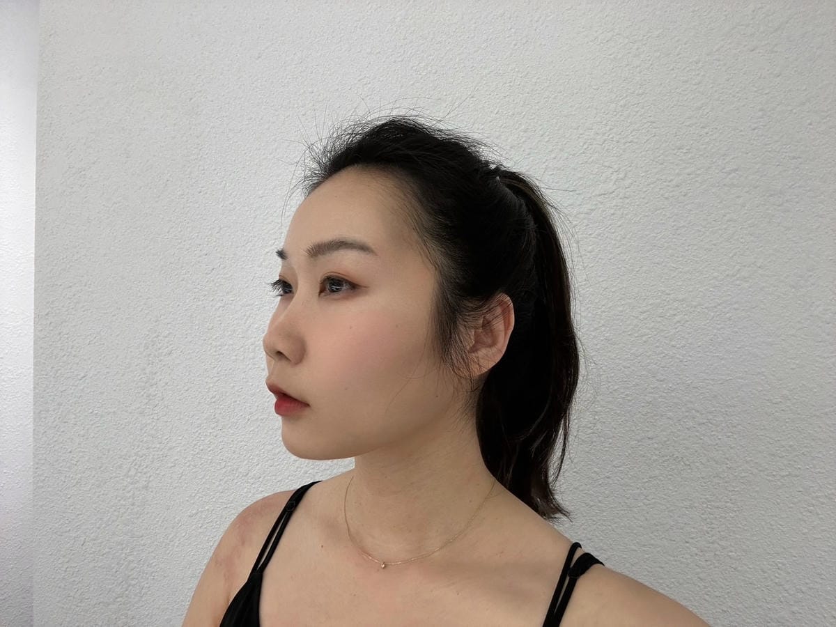 改善咀嚼肌肉毒瘦小臉有感│GM冠美國際時尚診所 改善咀嚼肌肉毒瘦小臉有感│GM冠美國際時尚診所