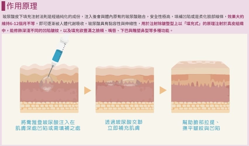 關於微整形功課，喬雅登VOLBELLA玻尿酸淚溝施打推薦！不