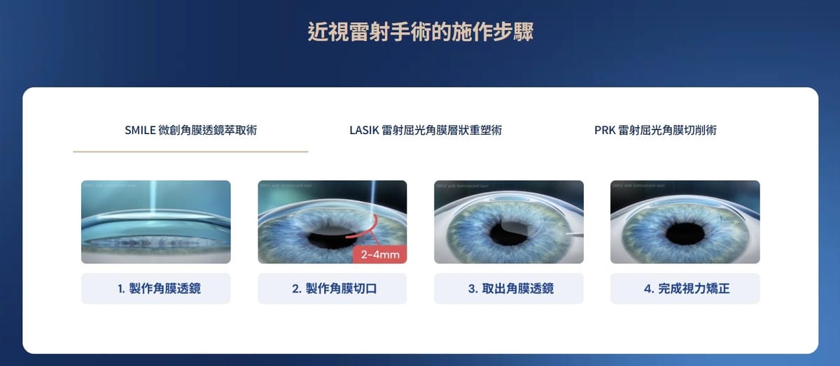 台北近視雷射推薦｜SMILE Pro 2.0微創全飛秒近視雷