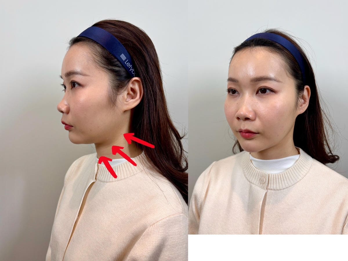 肉肉臉、雙下巴有救了！ONDA超微波讓我臉小一號 │ 悅緹妍