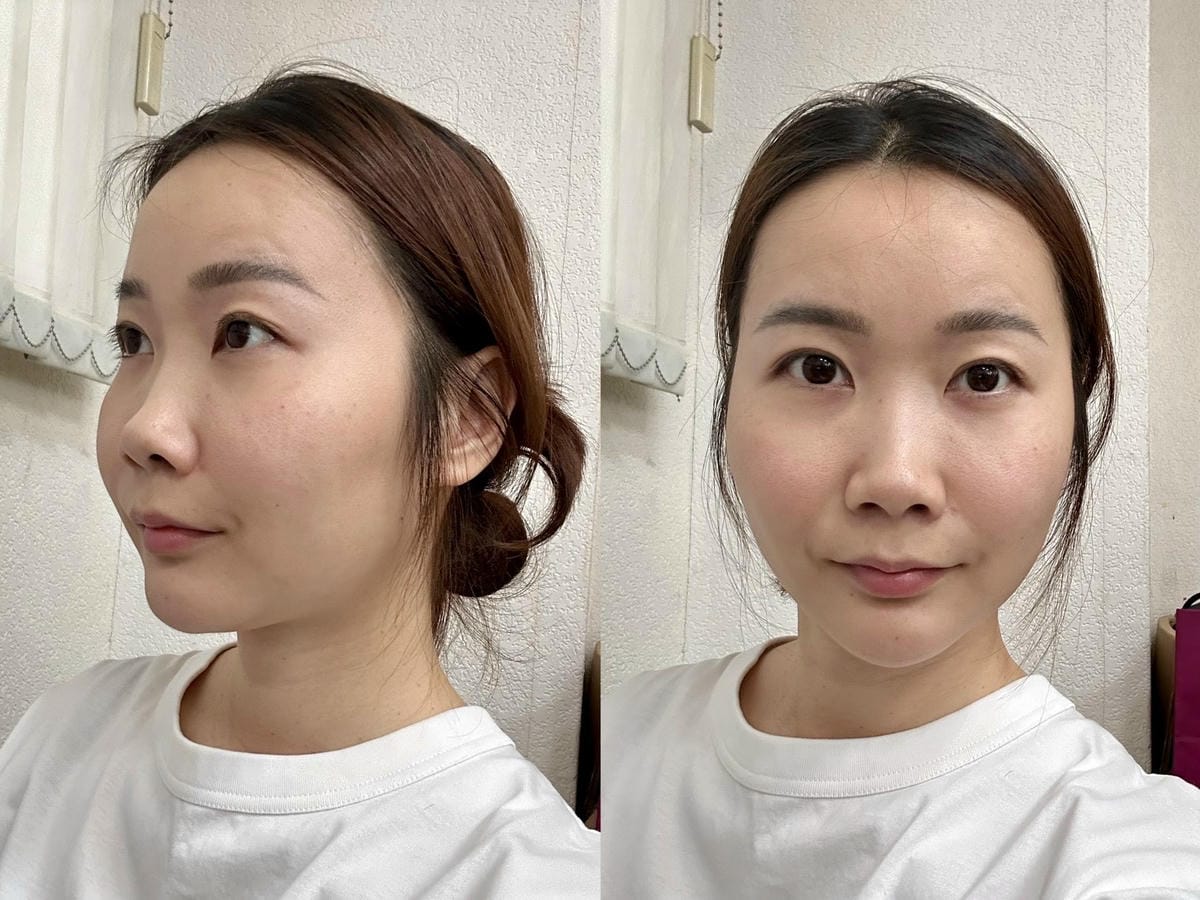 偷偷變美日記｜松江南京 九五太承醫美診所Z音波+雙線音波體驗