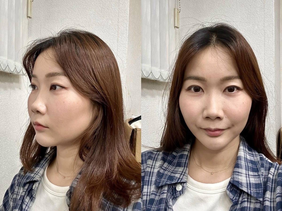 偷偷變美日記｜松江南京 九五太承醫美診所Z音波+雙線音波體驗
